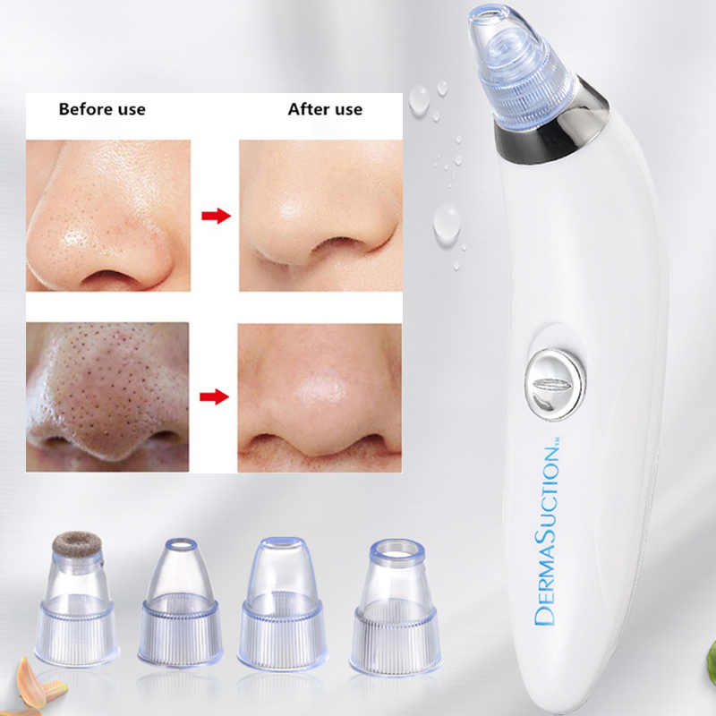 Suction Blackhead Remover