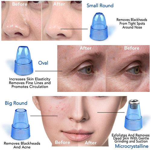 Suction Blackhead Remover
